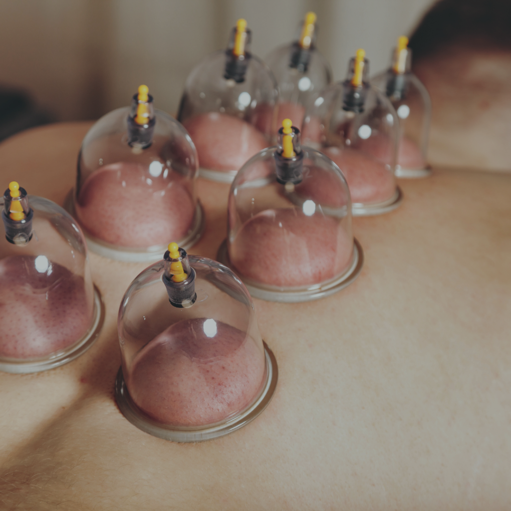 Cupping Therapy: What Does It Actually Do